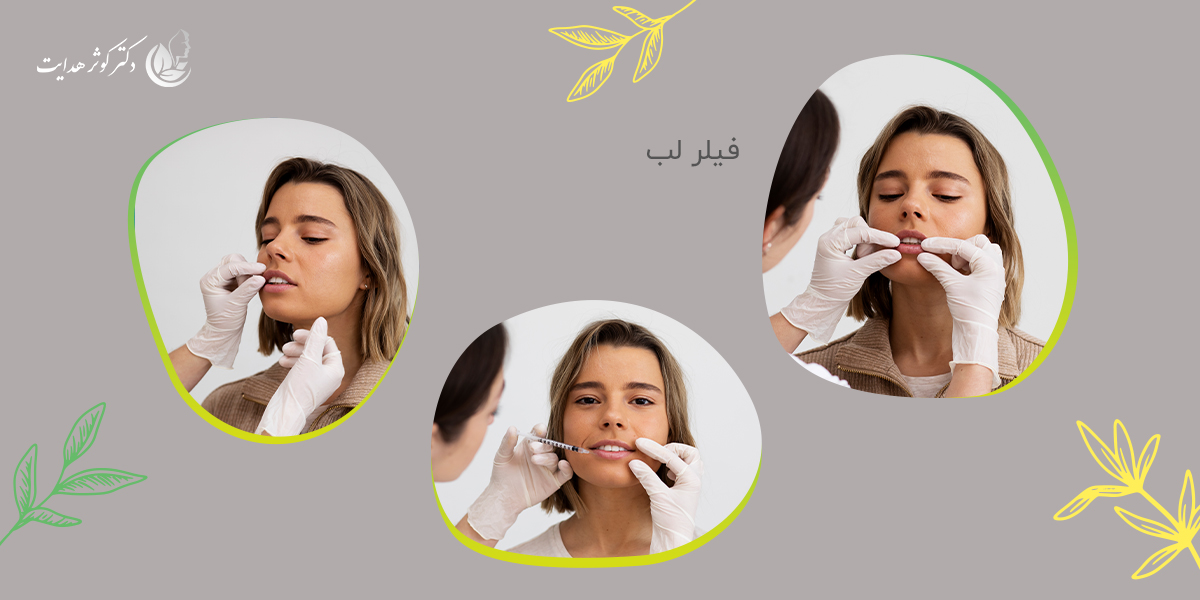 فیلر لب