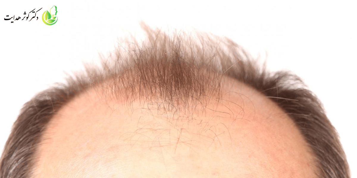 ریزش موی ارثی چیست و چگونگی کاهش عوامل ریزش مو