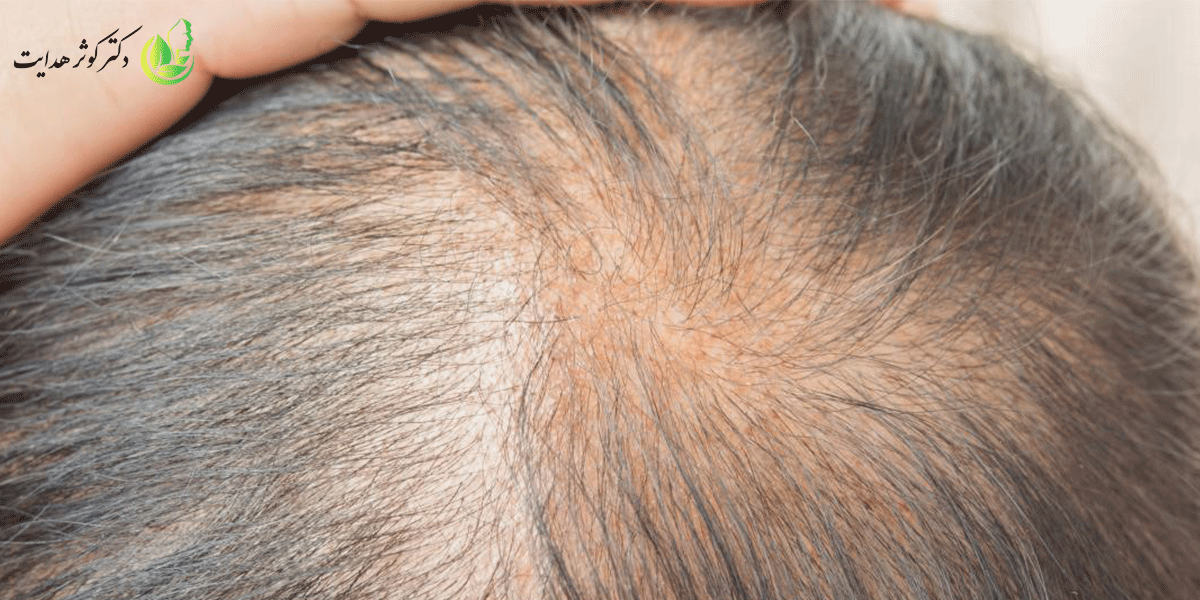 ریزش موی ارثی چیست و چگونگی کاهش عوامل ریزش مو
