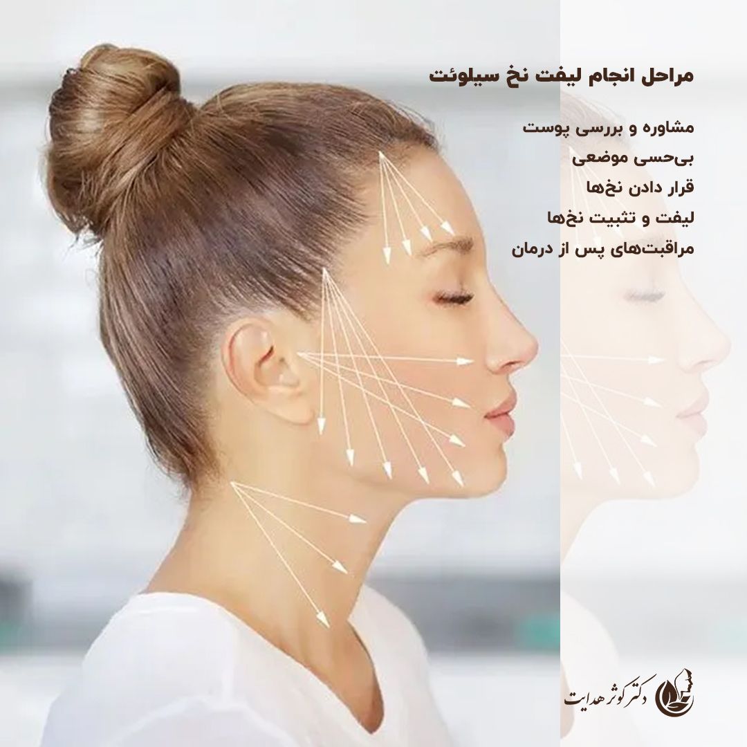 لیفت نخ سیلوئت؛ انقلابی در جوان‌سازی پوست