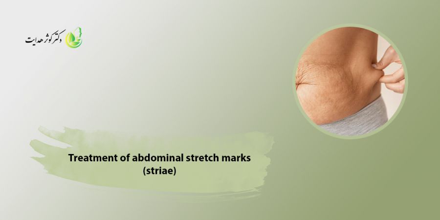 درمان ترک‌های شکمی (استریا)